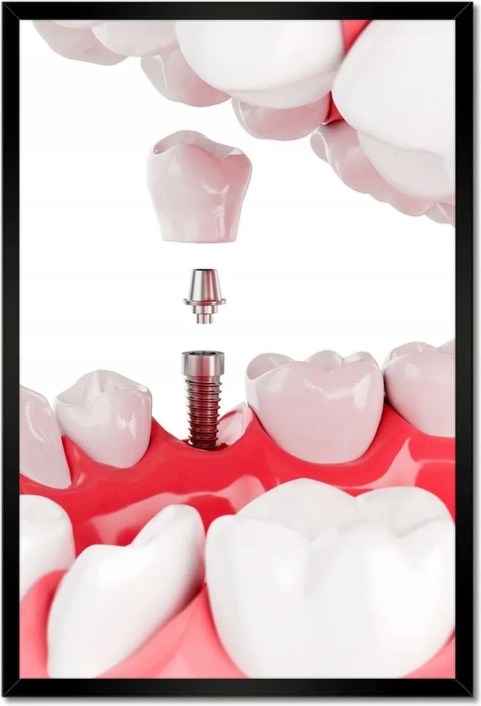 Poszterek keretben 40x60 Fogászati implantátumok