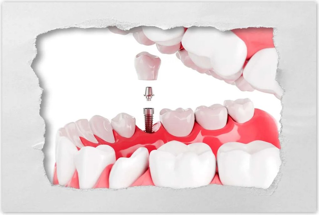 Poszterek 90x60 Fogászati implantátumok
