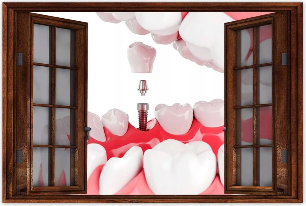 Poszterek 90x60 Fogászati implantátumok