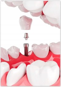 Poszterek 70x100 Fogászati implantátumok