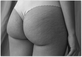 Poszterek 100x70 fenék striák a fenéken