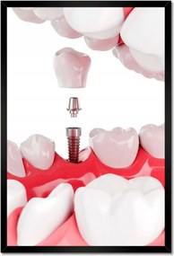 Poszterek keretben 40x60 Fogászati implantátumok