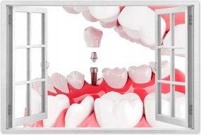 Poszterek 90x60 Fogászati implantátumok